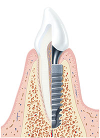 Implantologie Implantate Zahn Zahnersatz